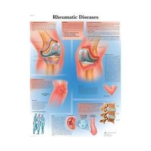 Rheumatic Diseases   Anatomical Chart  Industrial 