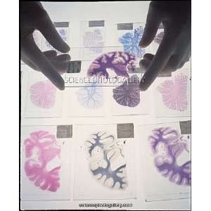 Gloved hands and human brain sections on light box 