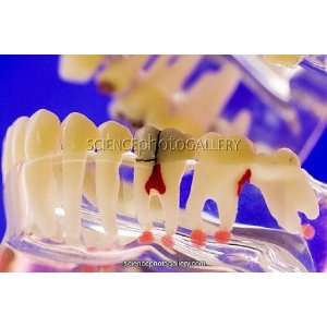  Tooth disorders, dental model Framed Prints