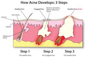 Best Acne Blemish Treatment Pill DETOX SKIN balance hormone ACNEPRIL 